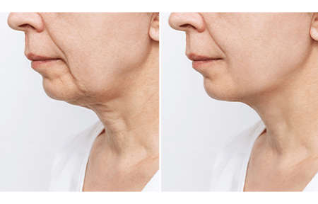 Hyaluronic Acid Before and After Transforming Skin Health